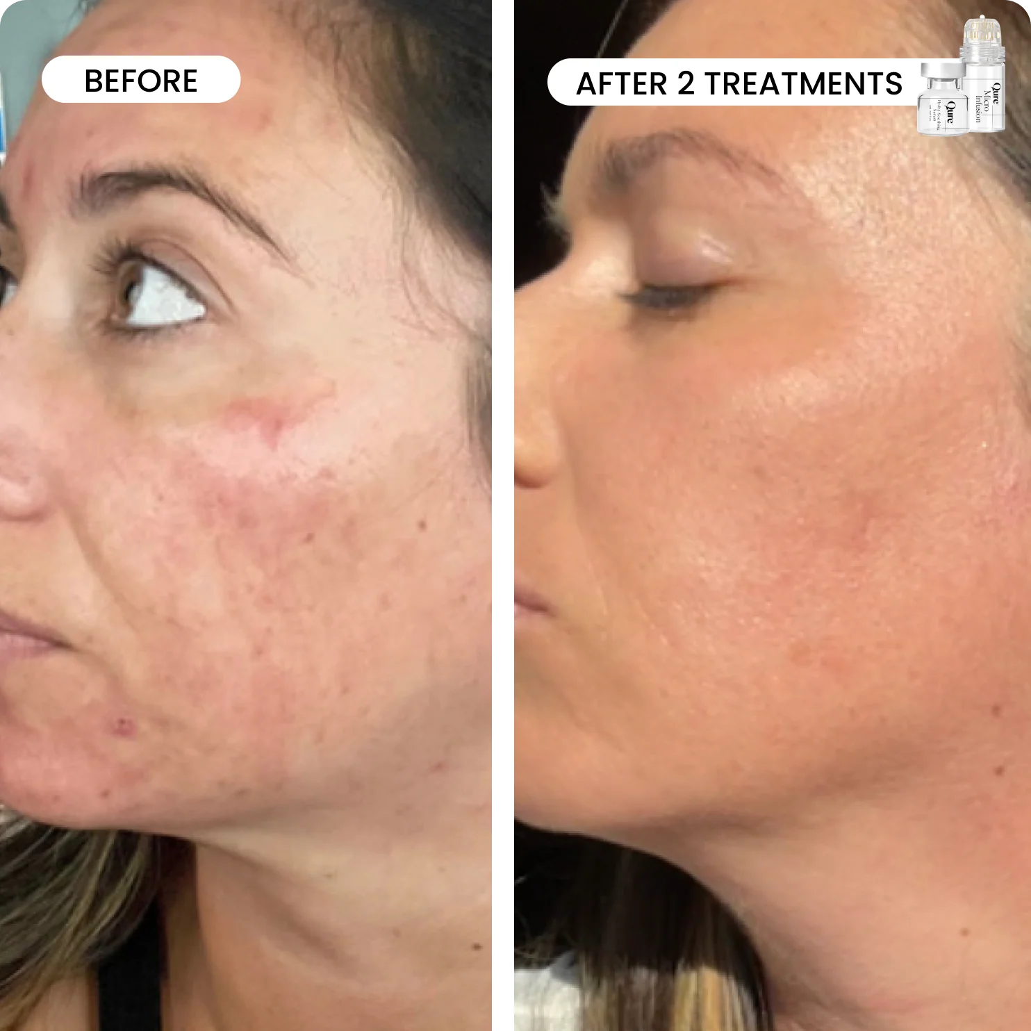 Micro-Infusion 1 Month Bundle (For Dark Spots) - Image 3