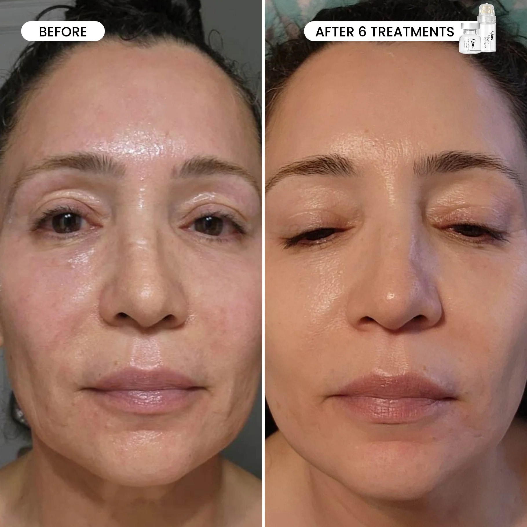 Micro-Infusion 3 Month Bundle (For Wrinkles) - Image 6
