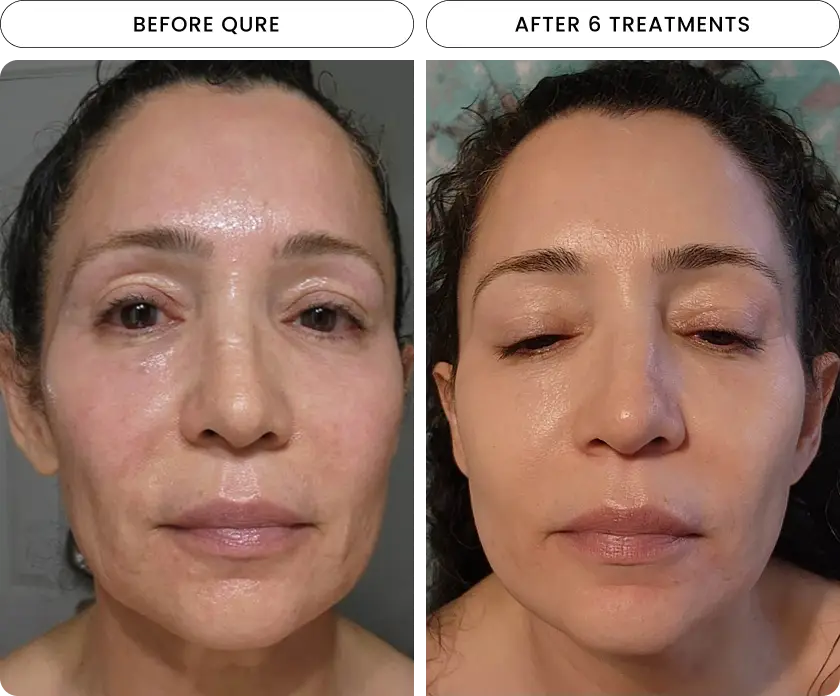 Micro-Infusion 6 Month Bundle (For Wrinkles) - Image 3